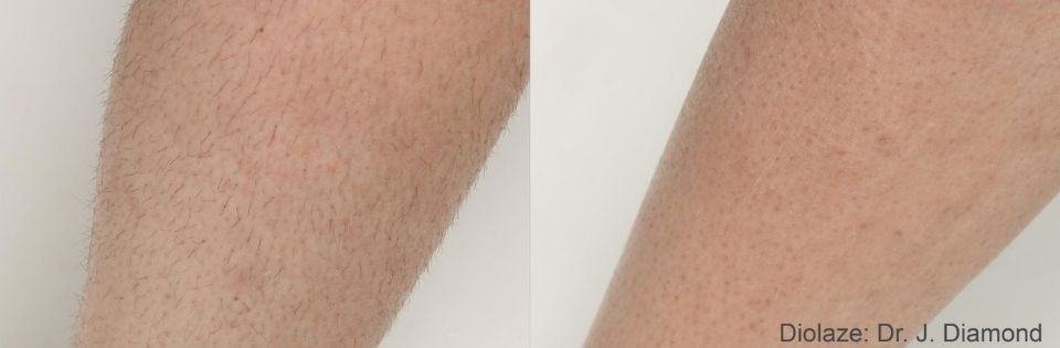 Before And After Treatment | Absolute Health Care | Newnan GA