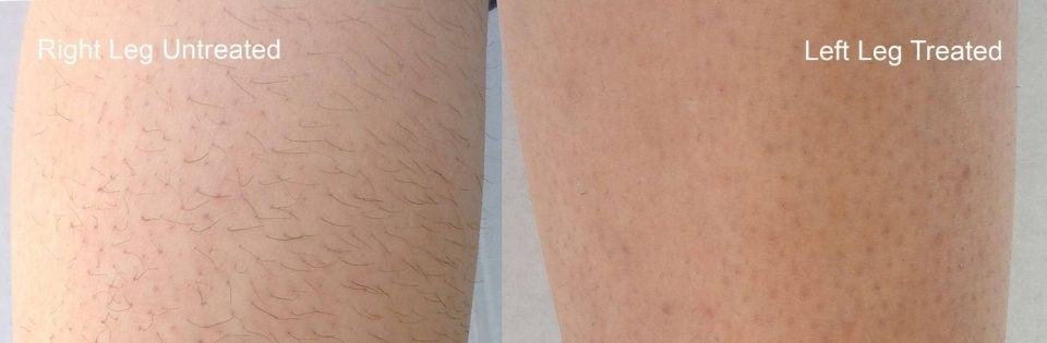 Before And After Treatment | Absolute Health Care | Newnan GA