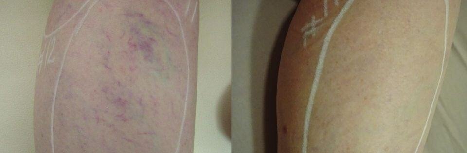 Before And After Treatment | Absolute Health Care | Newnan GA