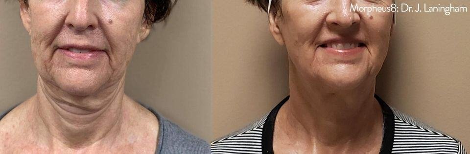 Before And After | Absolute Health Care | Newnan GA