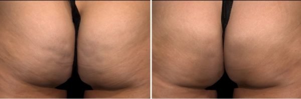 Before And After Treatment | Absolute Health Care | Newnan GA