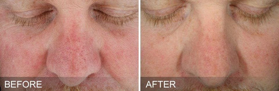 Before And After Treatment | Absolute Health Care | Newnan GA