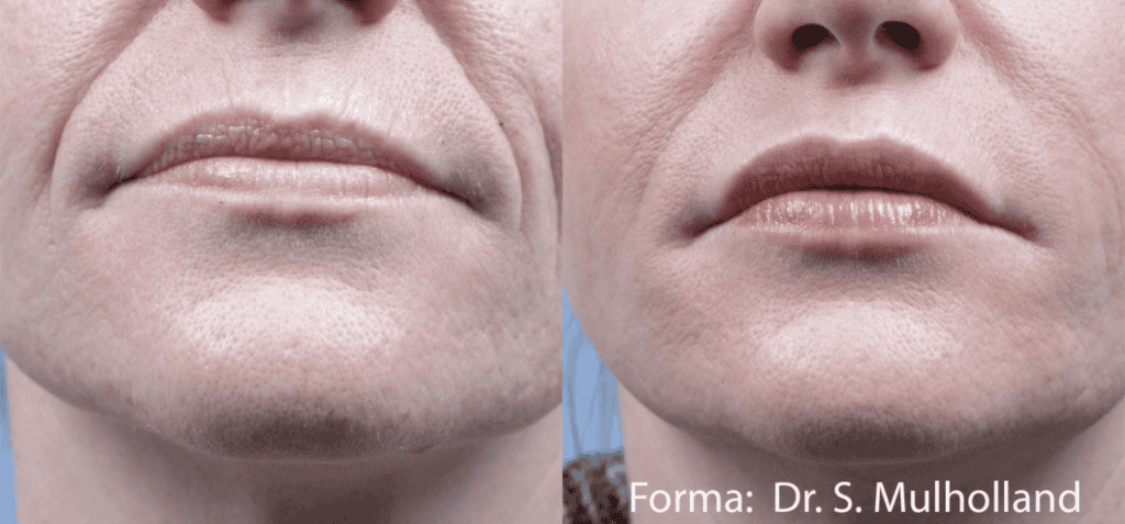 Before And After Lips | Absolute Health care | Newnan GA