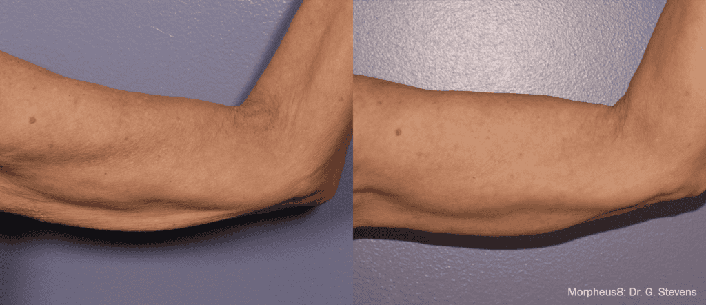 Before And After Morpheus | Absolute Health care | Newnan GA