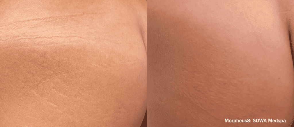 Before And After Morpheus | Absolute Health care | Newnan GA