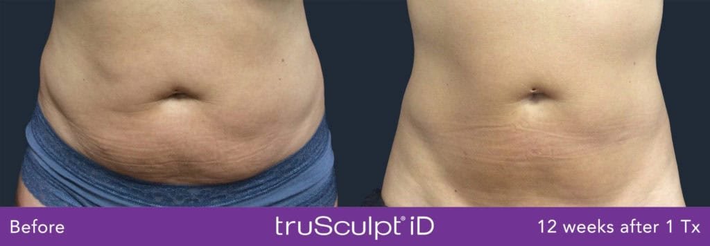TruSculpt ID